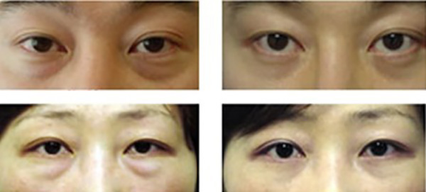 eye-bag-removal-photo1611.jpg