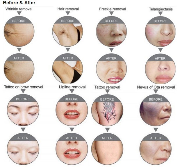 Beauty Equipment